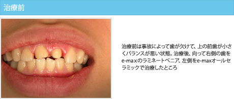 治療前は事故によって歯が欠けて、上の前歯が小さくバランスが悪い状態。治療後、向って右側の歯をe-maｘのラミネートべニア、左側をe-maxオールセラミックで治療したところ。