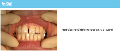 治療前は上の前歯部分の間が開いている状態