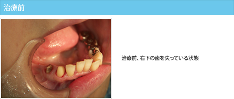 治療前、右下の歯を失っている状態